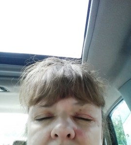 Poison Ivy by nose and on eyelids. It itches.